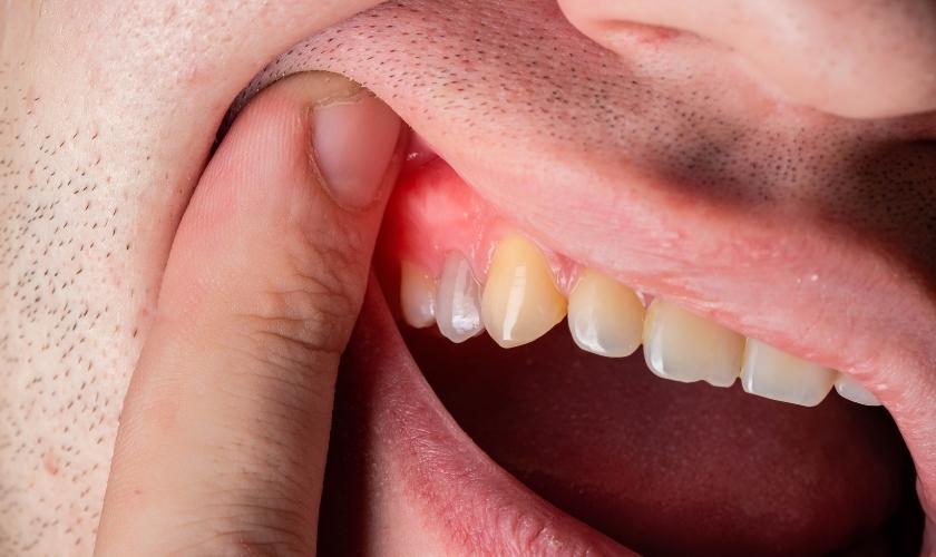 dental abscess photo